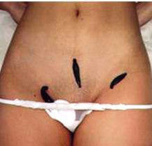 Leech Therapy: OBGYN / Female Reproductive System Problems
