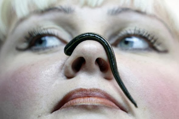 Leech Therapy for Acne, Skin Lumps, Bumps, Cancer & Tumors