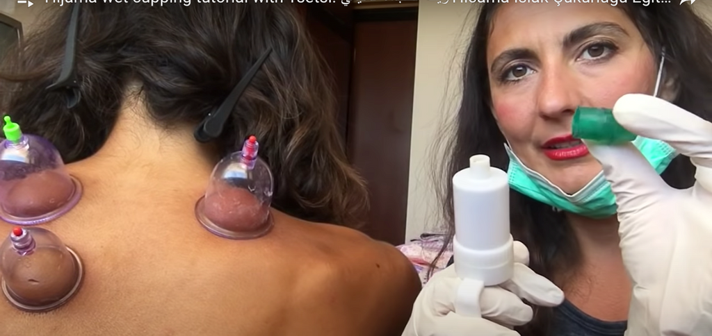 Hijama wet cupping tutorial with Tsetsi