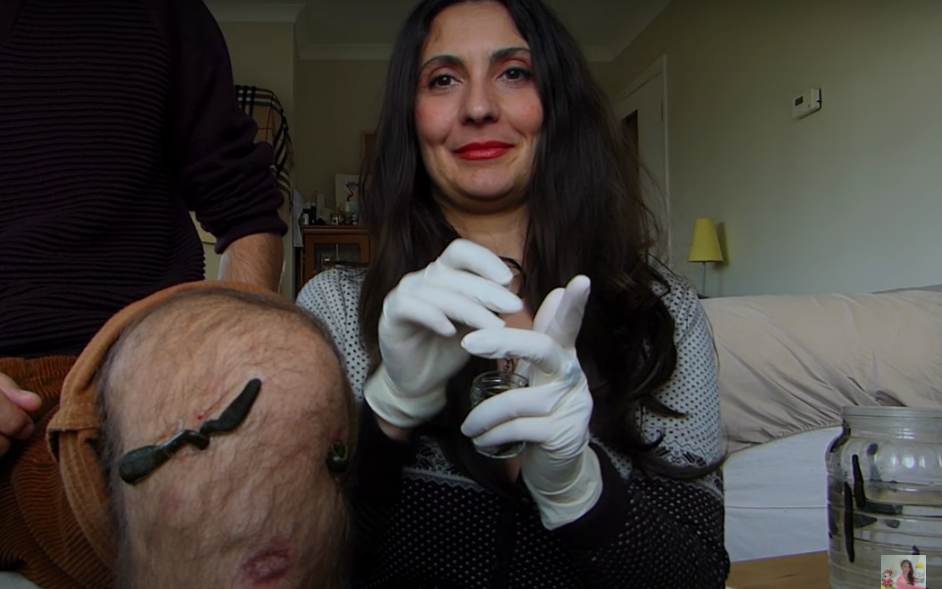 Knee Pain Leech Therapy by Medical Leeches.