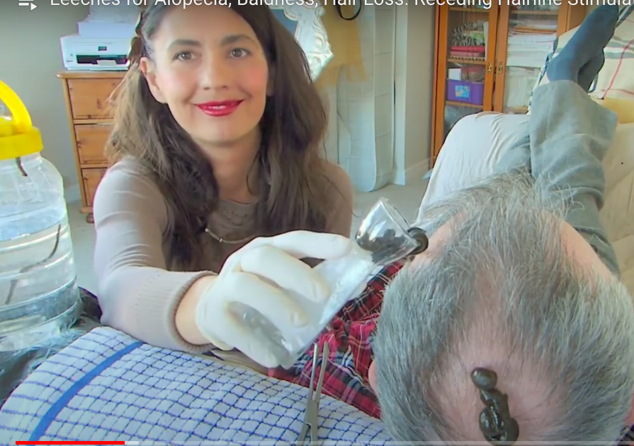 Leeches for Alopecia, Baldness, Hair Loss. Receding Hairline Stimulation