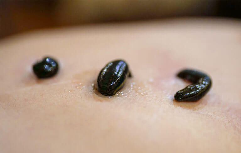 Background Information on Leech Therapy