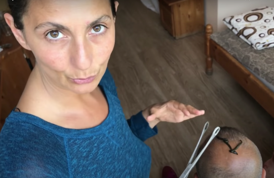 Hirudotherapy for balding