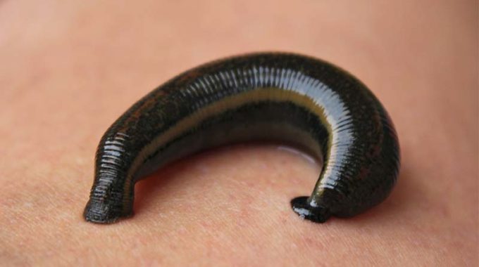 Leech Therapy in all its Versatility