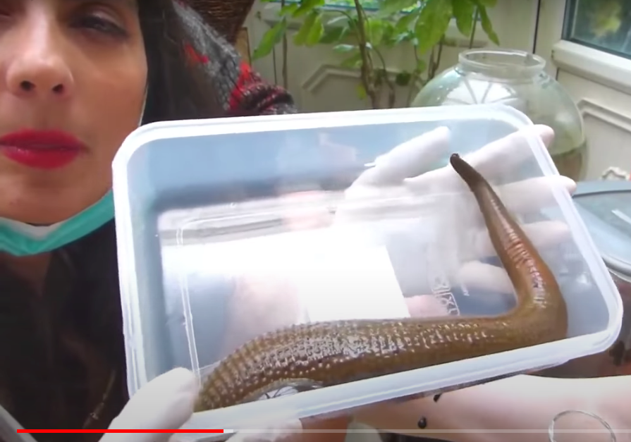 Leech Therapy for Varicose Veins.