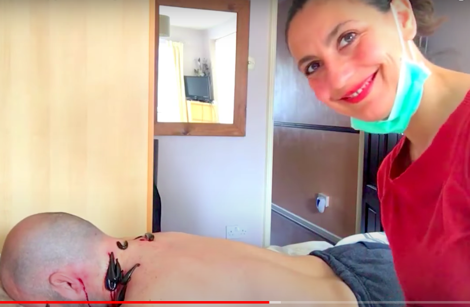 Leech Therapy for Vertigo & Dizziness. Stiff neck & Shoulders Hirudotherapy.