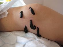 Use of Leech Therapy