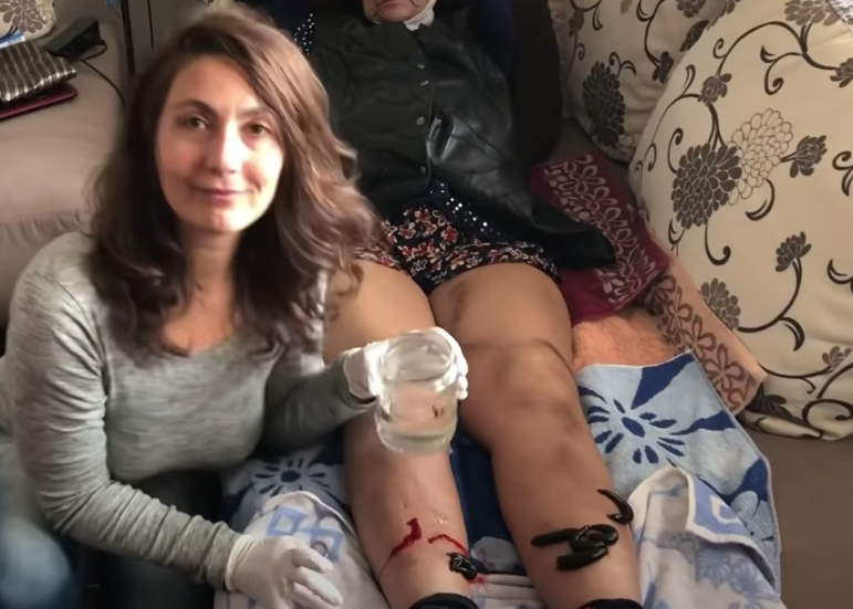 Leech Therapy: Varicose Veins