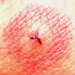 Leech bites & Getting a Leech High