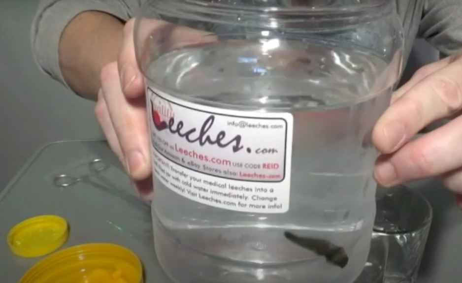 Leeches????