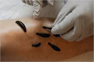 What is Leech Therapy?