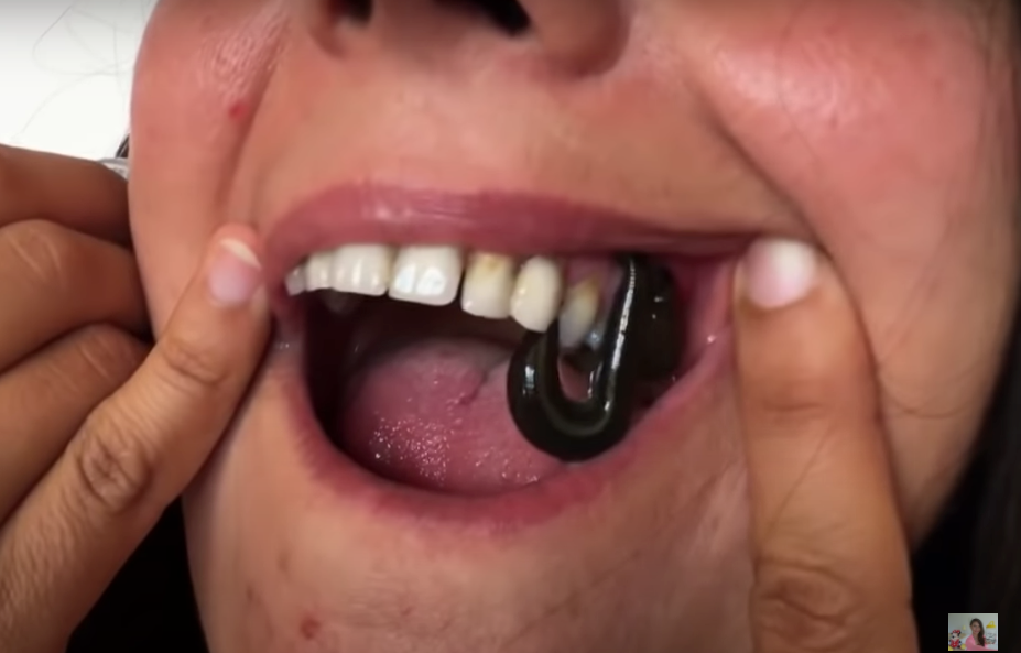 Medical Leeches for Tooth Ache by Leech Therapy.